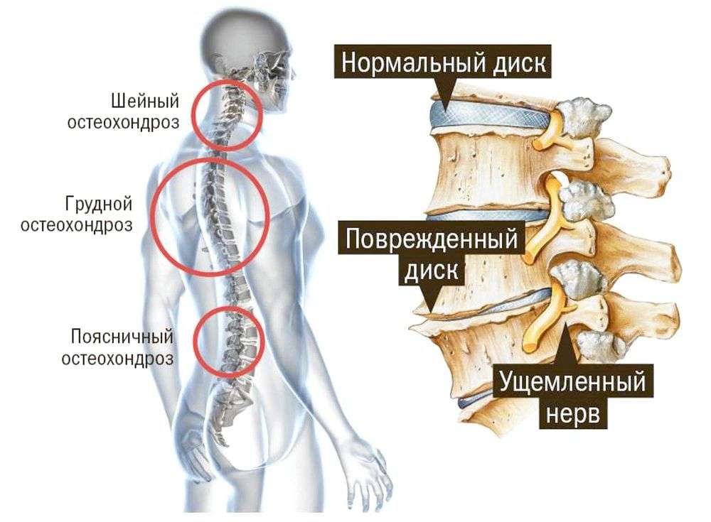 Остеохондроз шейно-грудного отдела позвоночника