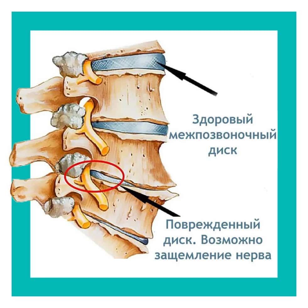 Корешковым синдромом
