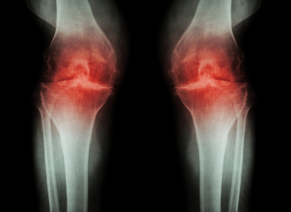 признаки артрита коленного сустава