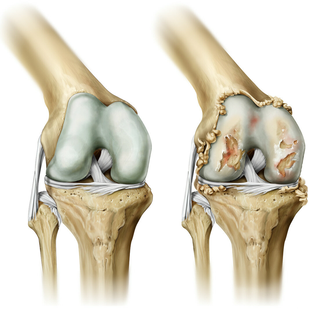 артрит коленного сустава симптомы