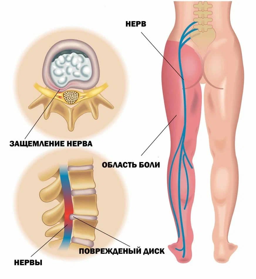 защемление седалищного нерва лечение