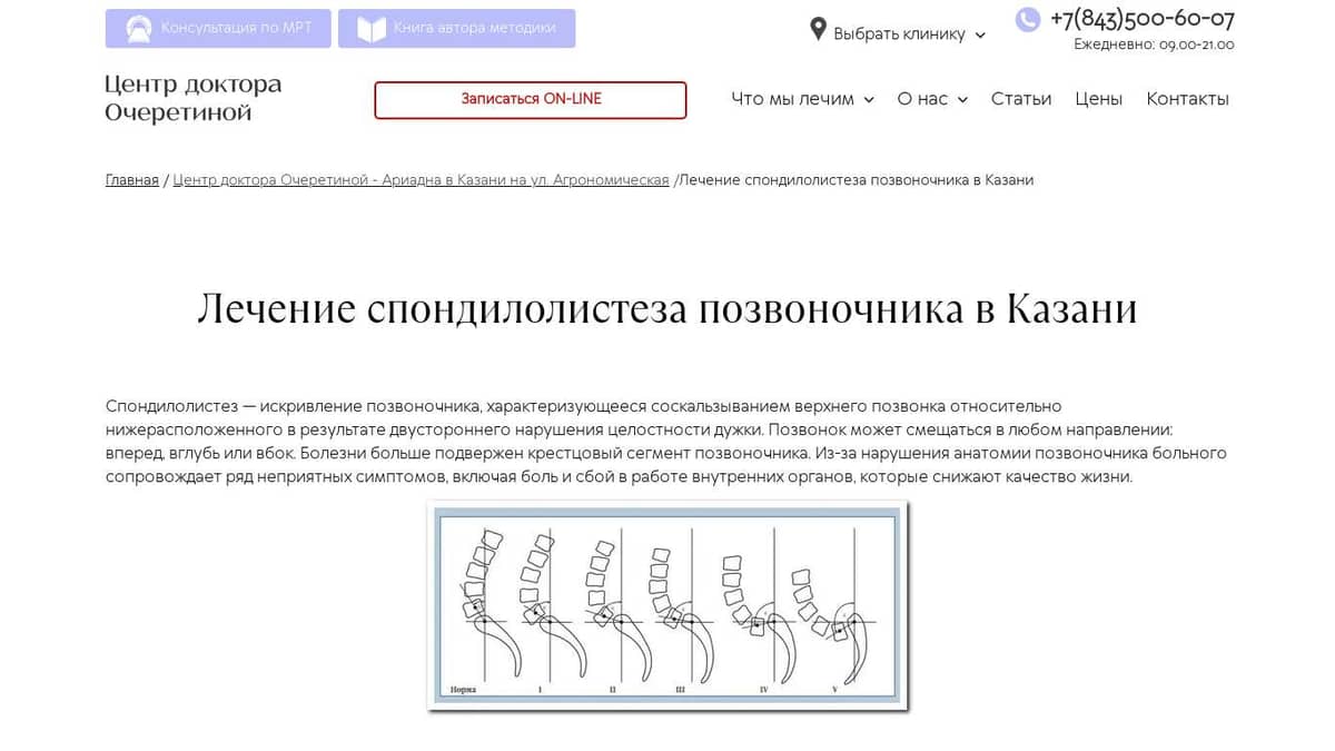 Лечение спондилолистеза позвоночника в Казани