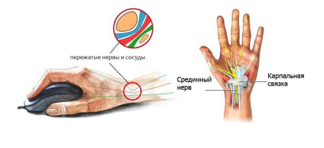 симптомы нейропатии срединного нерва на руке