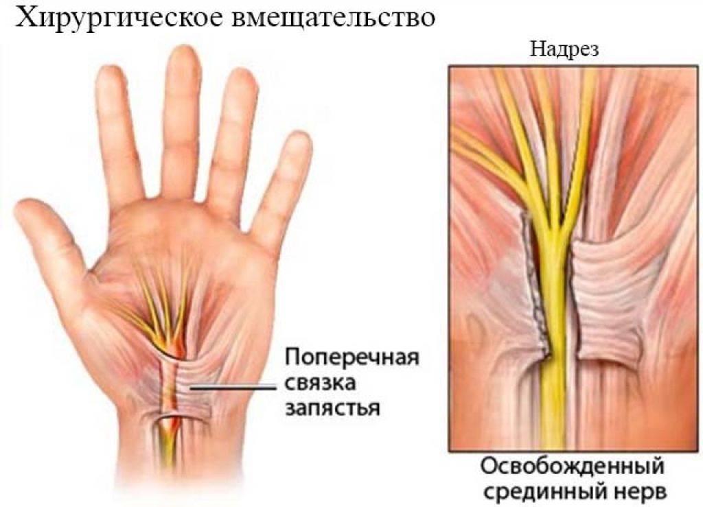 Нейропатия срединного нерва на руке — операция