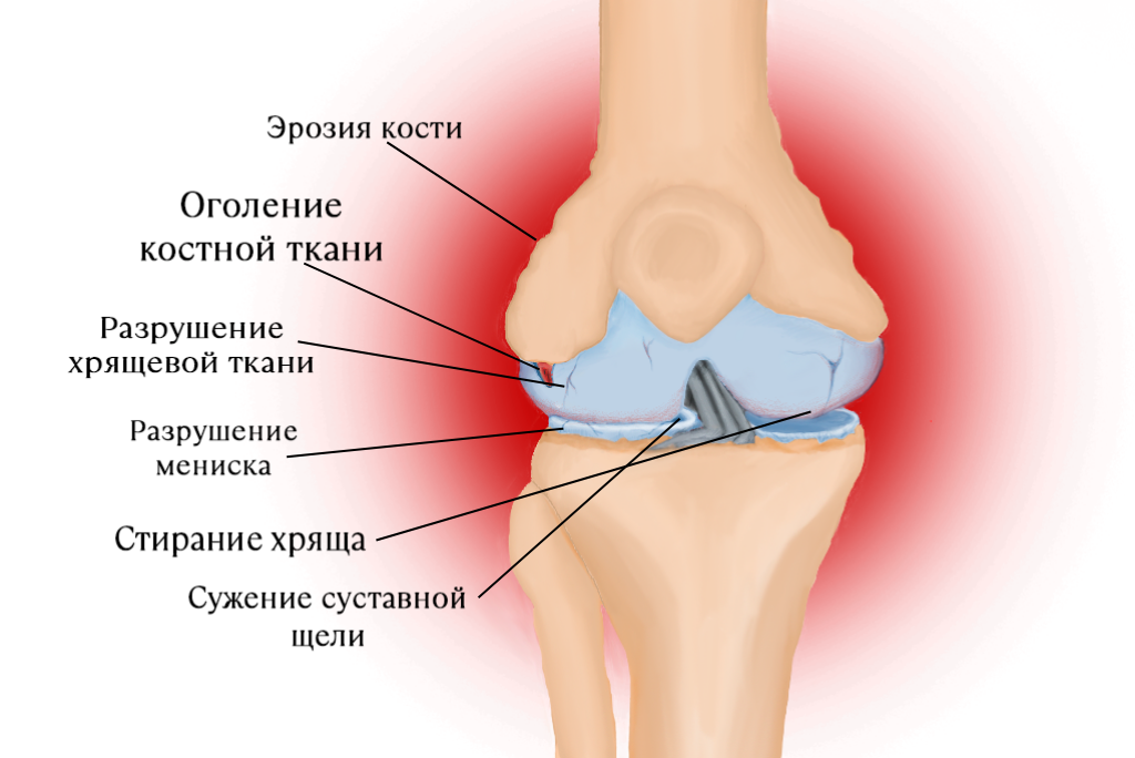 Эффективное лечение артроза колена без операции!