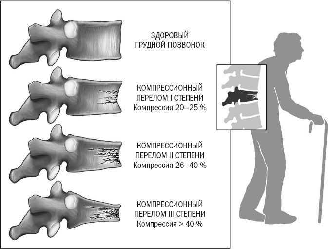 лечение компрессионного перелома позвонков в москве