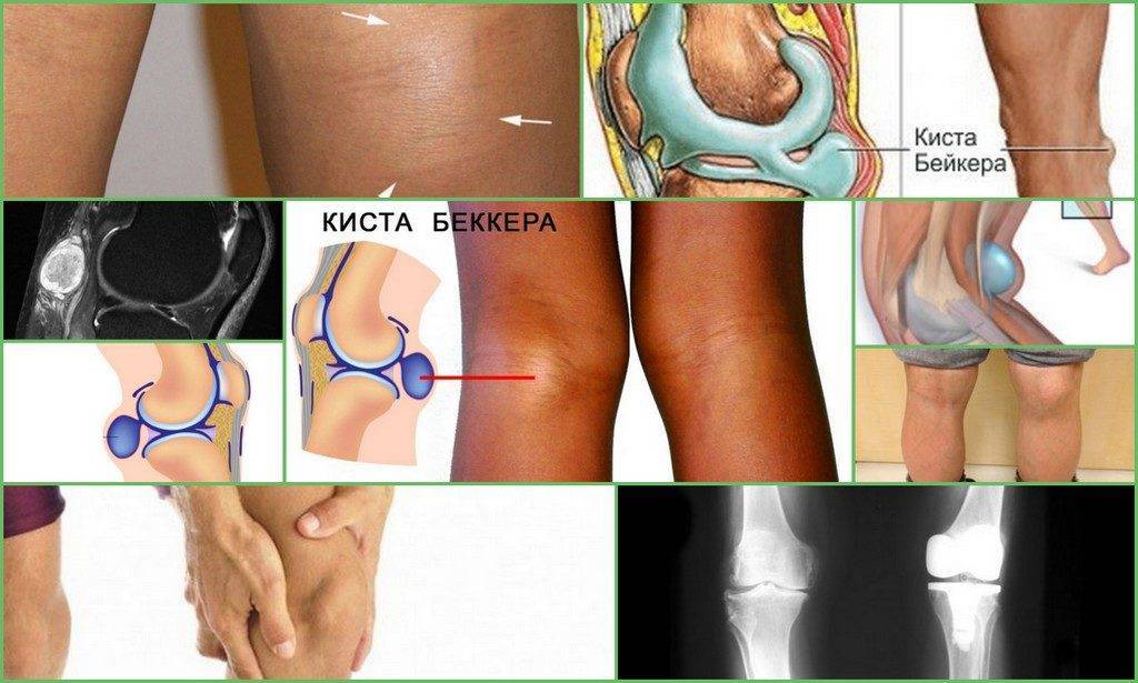 Диагностика кисты колена