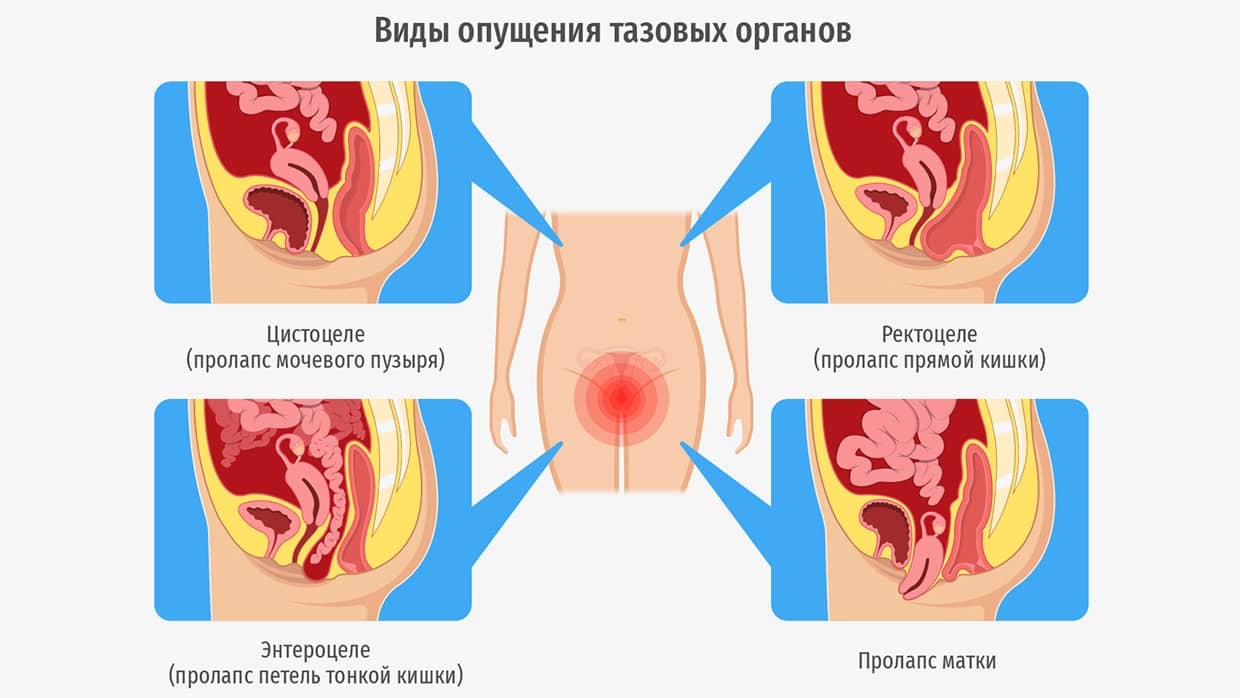 Причины опущения внутренних органов