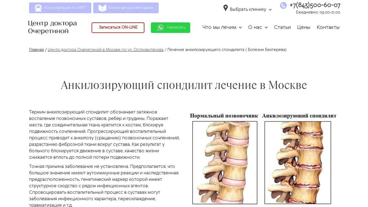 Анкилозирующий спондилит лечение в Москве