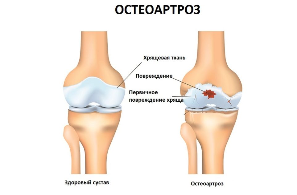 Как вылечить остеоартроз