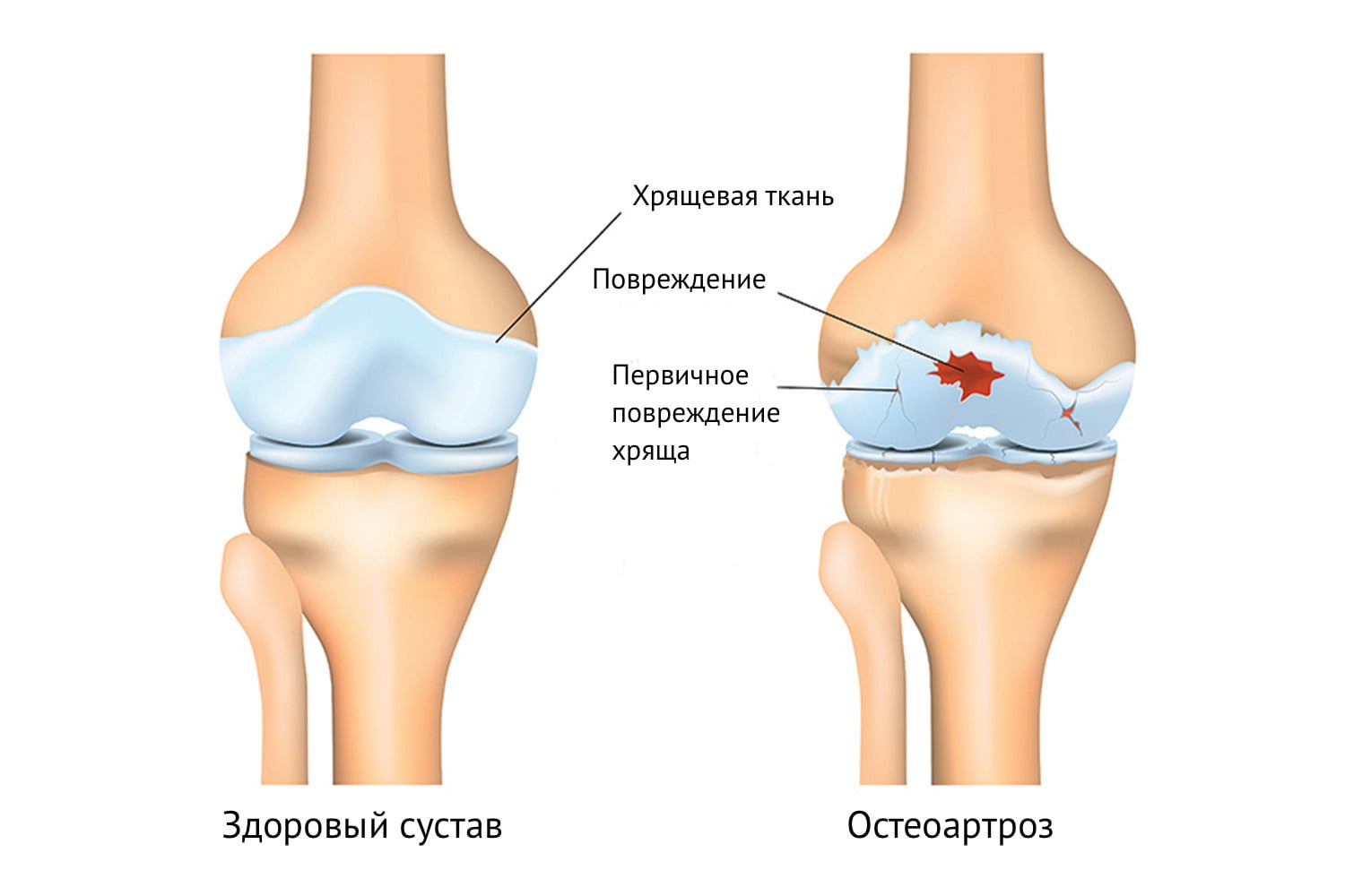 Остеоартроз - лечение по уникальной методике в Москве