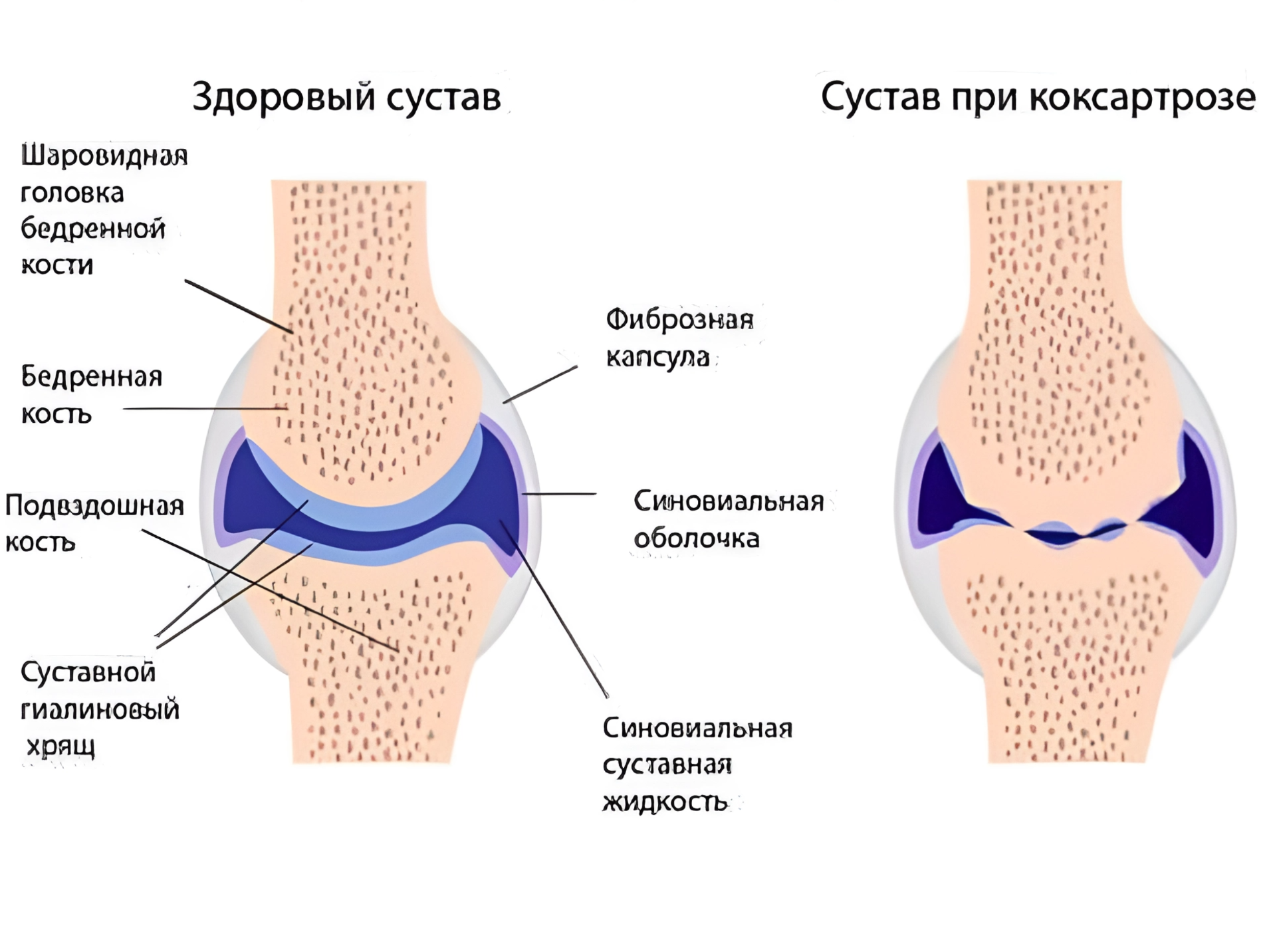 ​ Артроз тазобедренного сустава или коксартроз — лечение в Казани 