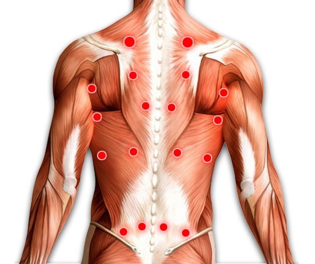 болевые точки в мышцах спины