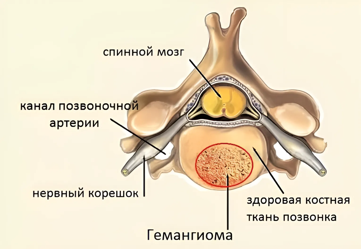 гемангиома в теле позвонка патогенез