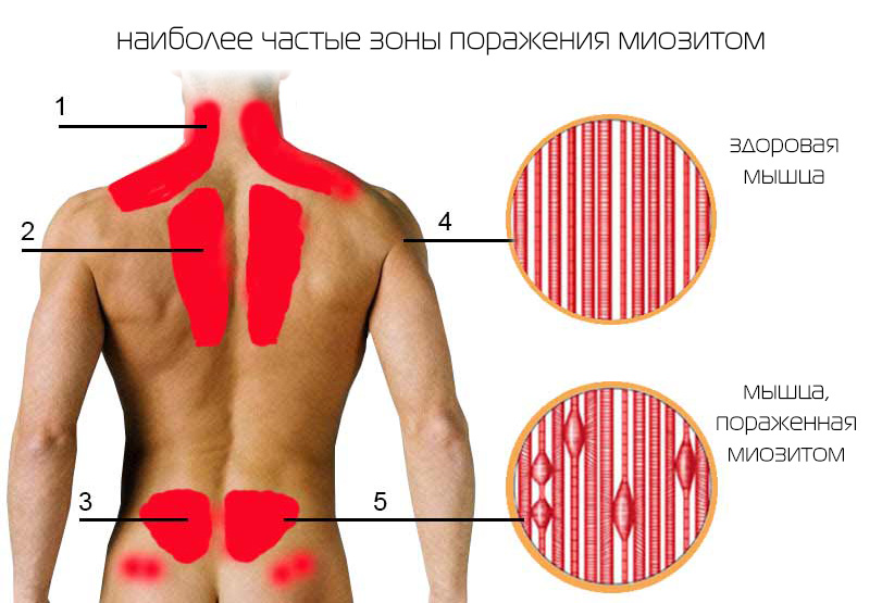 миозит мышц спины симптомы