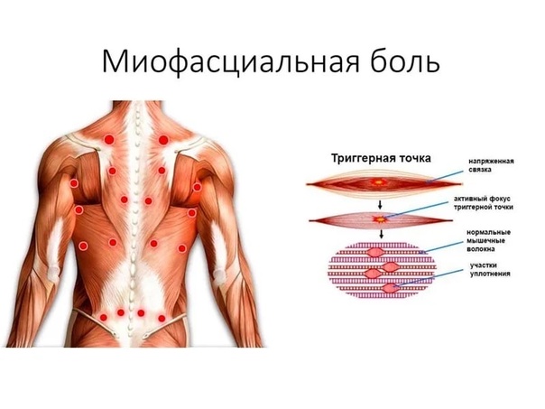 Что такое триггерные точки?