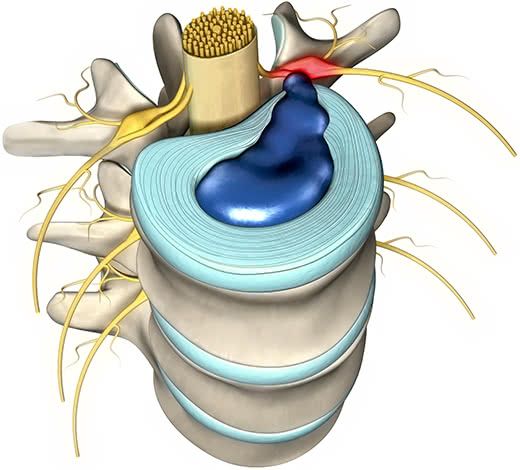 Чем опасна позвоночная грыжа?