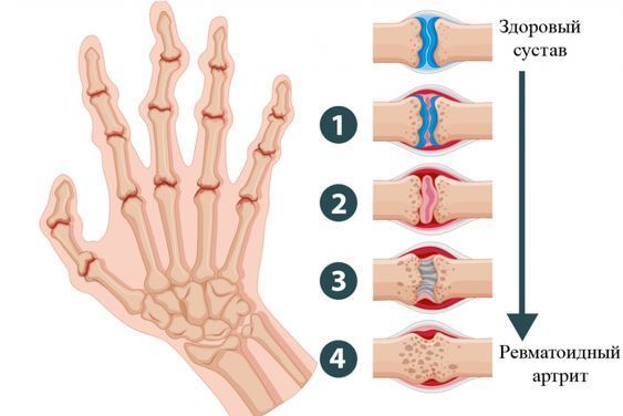 Деформирующий артроз рук