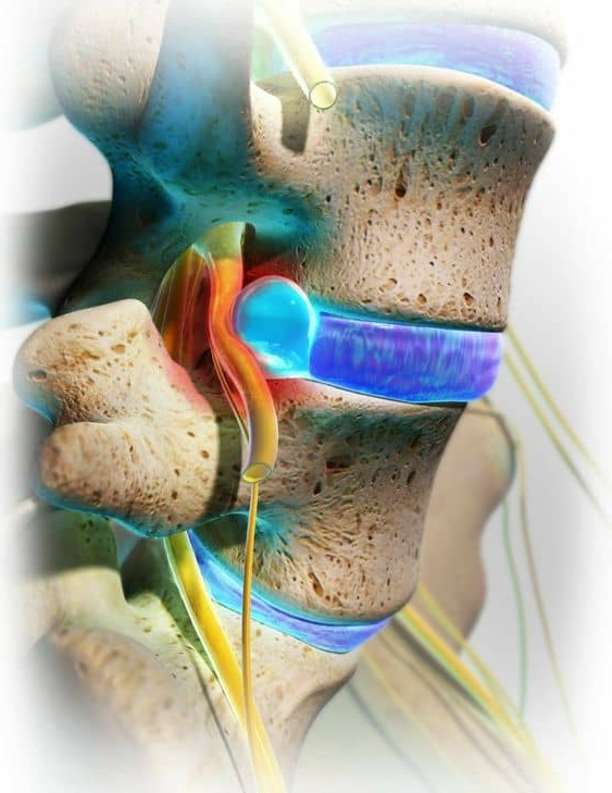 Удаление грыжи позвоночника