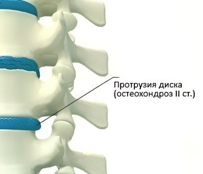 Билатеральная протрузия диска