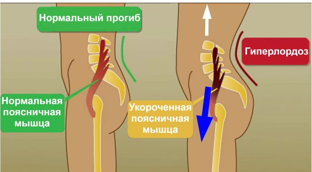 подвздошно-поясничная мышца