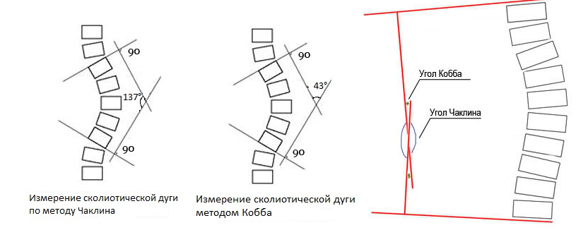 Оптимальный вариант лечения сколиоза