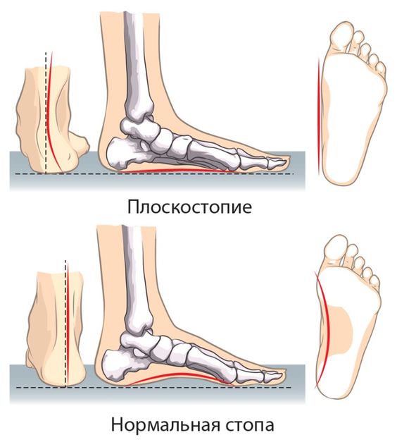 Плоскостопие у детей