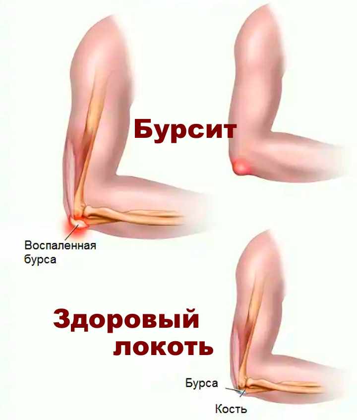 Локтевой бурсит