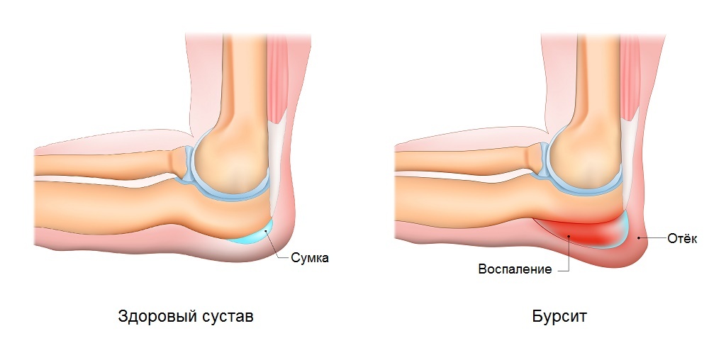 Локтевой бурсит