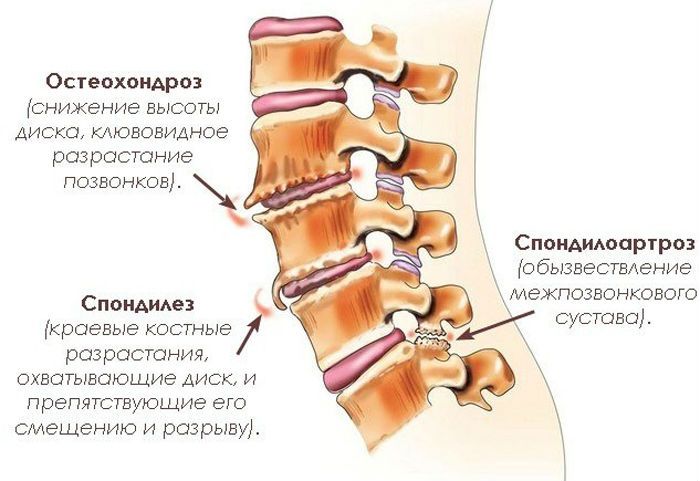 Деформирующий спондилез