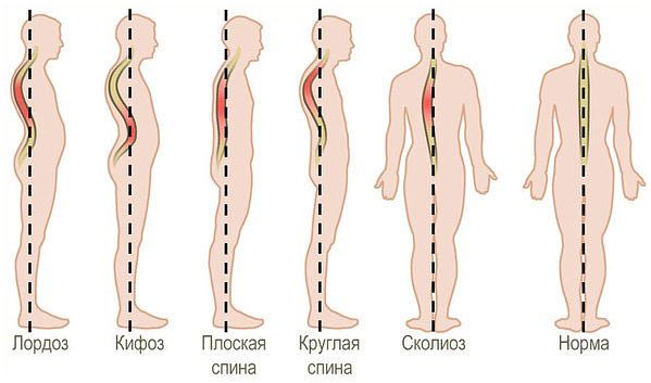 Выпрямлен физиологический лордоз