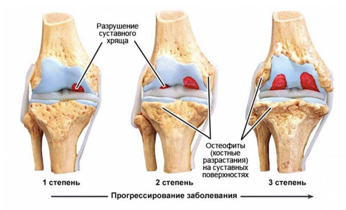 Гонартроз 2 стадии, симптомы, виды заболевания и лечение