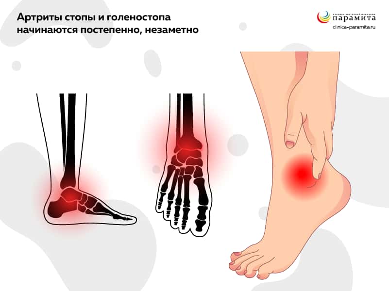 ​Артрит голеностопного сустава