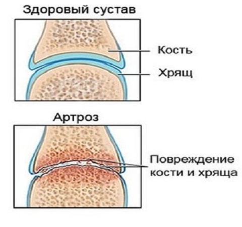 гимнастика при полиартрозе кистей рук