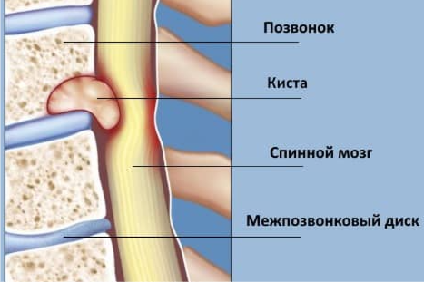 киста в позвоночнике