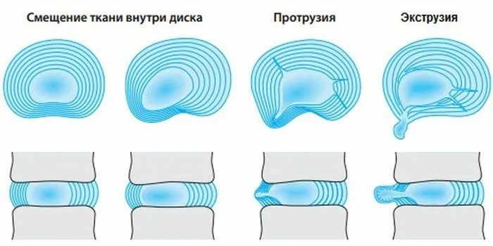 экструзия позвонка