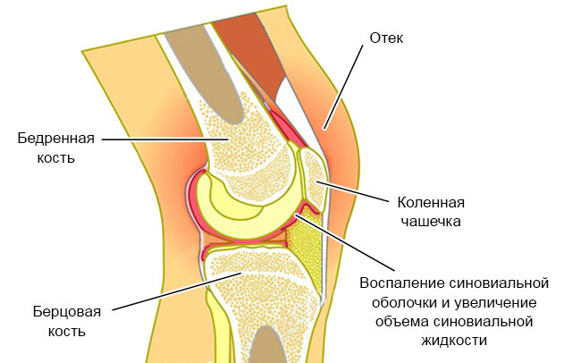 ​Умеренный синовит коленного сустава