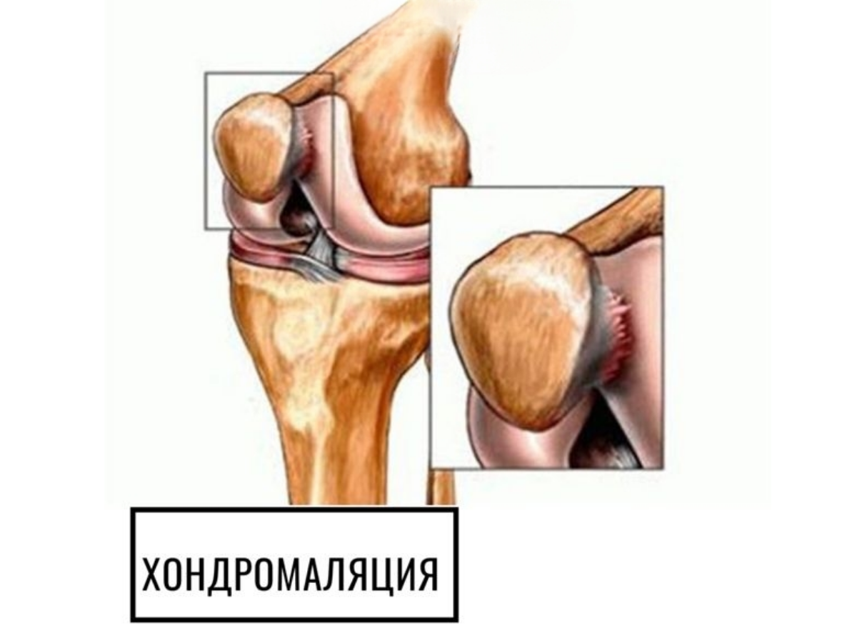 хондромаляция надколенника