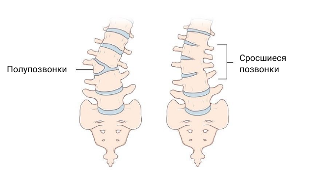 Аномалии развития позвоночника