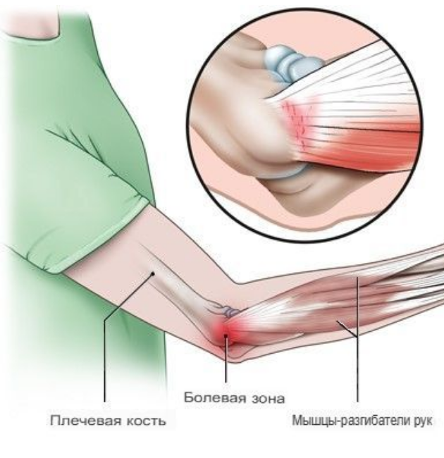 боль в правом локтевом суставе
