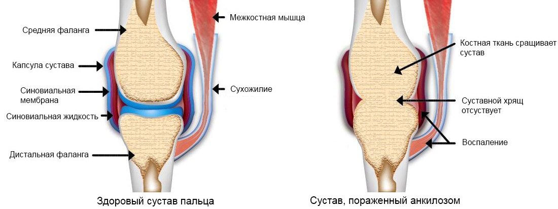 Анкилоз суставов