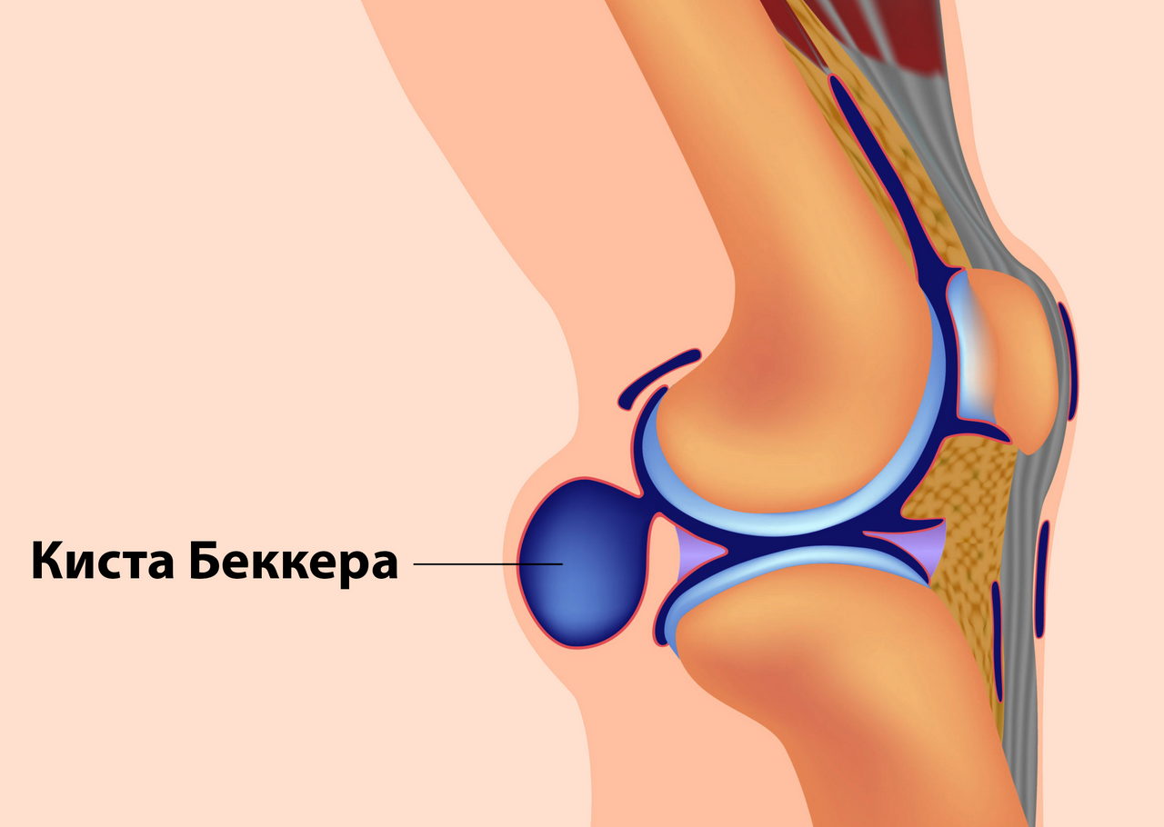 грыжа под коленом сзади