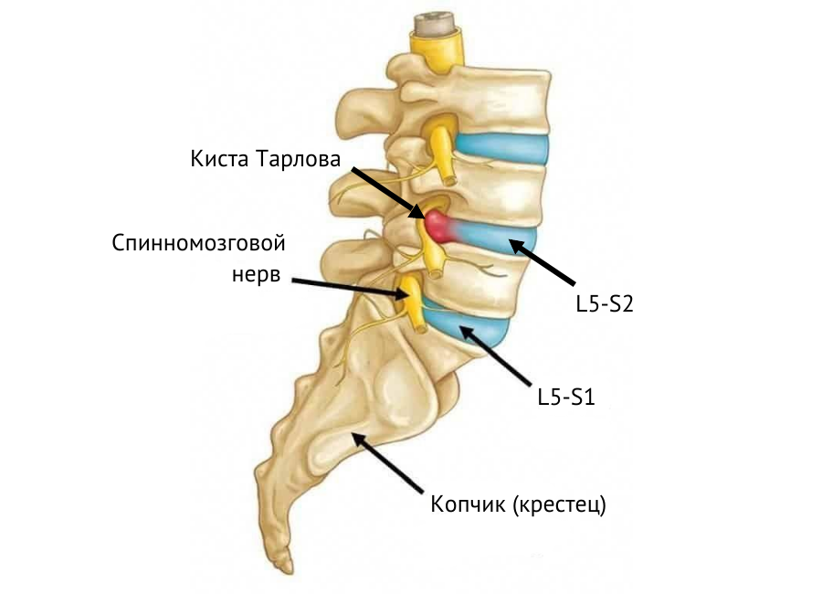 киста тарлова лечение