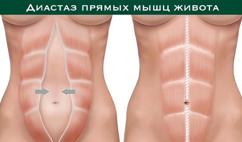 диастаз