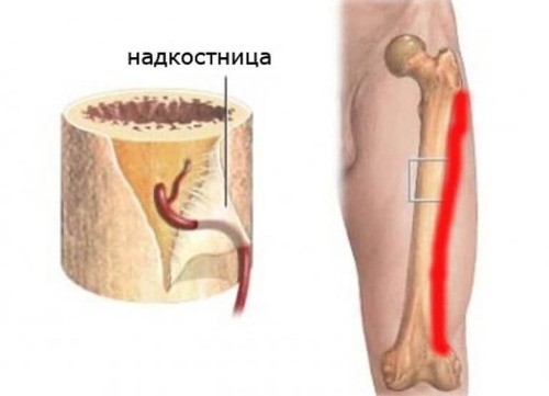 Периостит