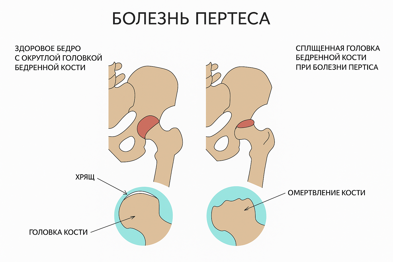 развития Пертеса