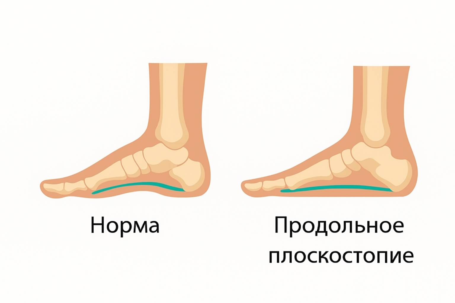 продольное плоскостопие